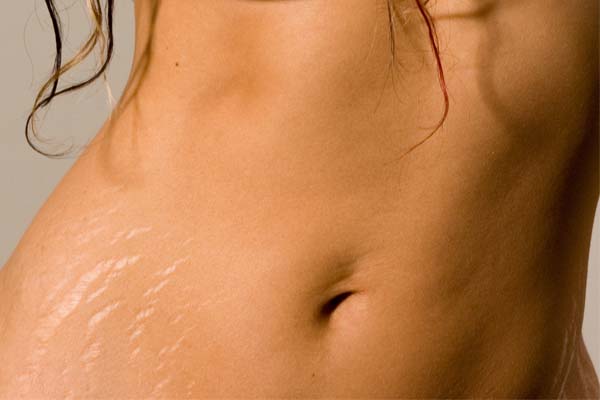 estrias prevencao tratamento Estrias: prevenção e tratamento