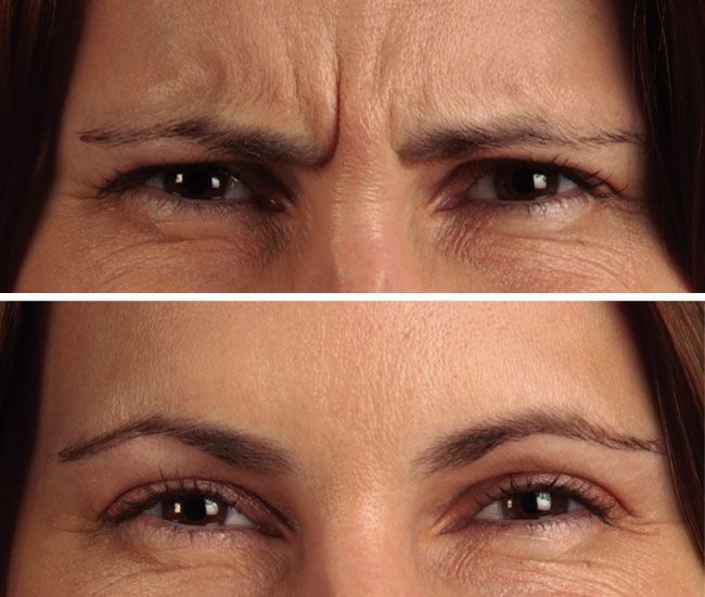 Saiba tudo sobre Botox - Dicas de Mulher