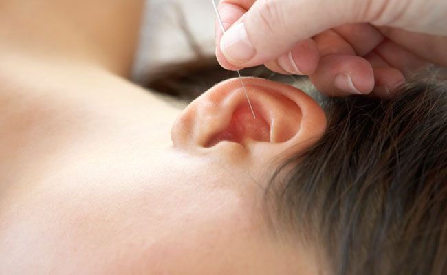 acupuntura auricular O que é acupuntura auricular?