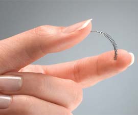 essure Essure, novo método contraceptivo