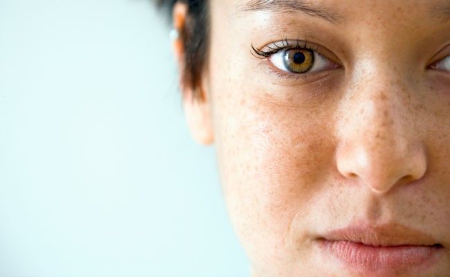 aprenda-a-diferenciar-os-tipos-de-manchas-na-pele