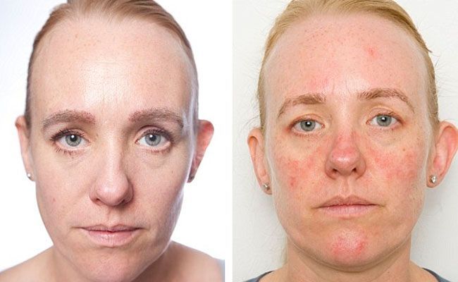 chemical peels Foto facial verses chemical peels Foto facial verses