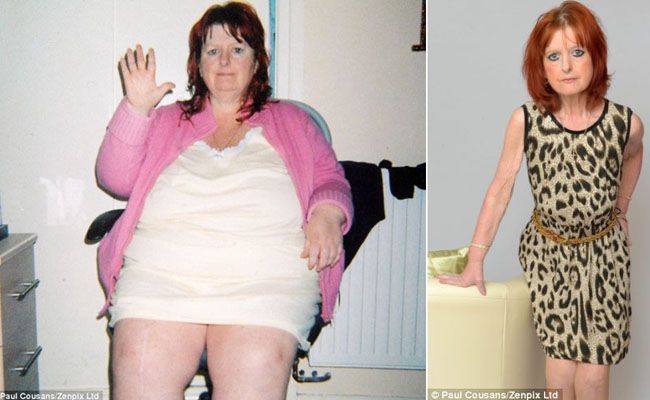mulher-faz-cirurgia-bariatrica-e-nao-consegue-parar-de-emagrecer
