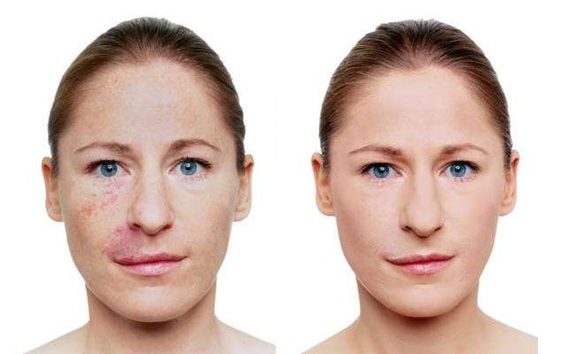 dermablend