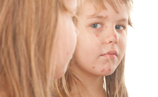 urticaria-infantil