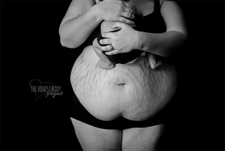 Foto: Reprodução / Natalie McCain / The Honest Body Project