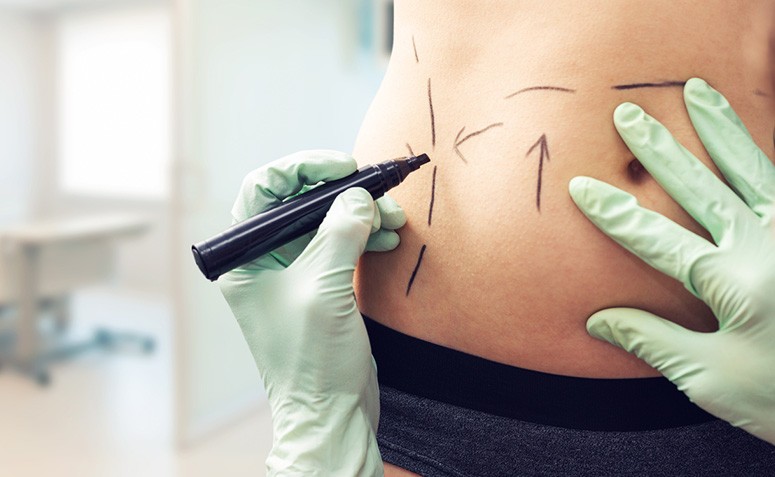 Abdominoplastia: 12 dúvidas sobre a plástica do abdômen esclarecidas