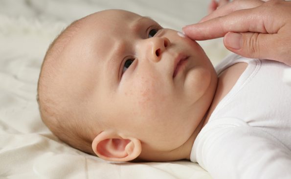 Brotoeja em bebês: veja as causas, saiba como tratar e prevenir