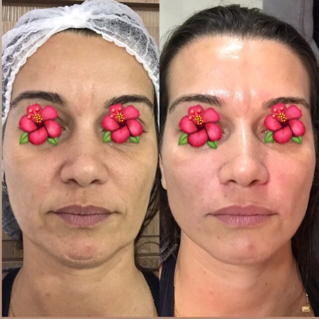 Bigode chinês: o que é, tratamentos e exercícios [ANTES E DEPOIS]