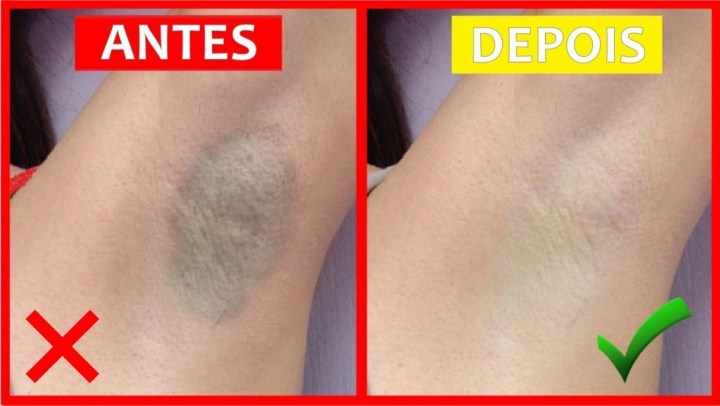 Como clarear as axilas: principais causas, prevenção e tratamento