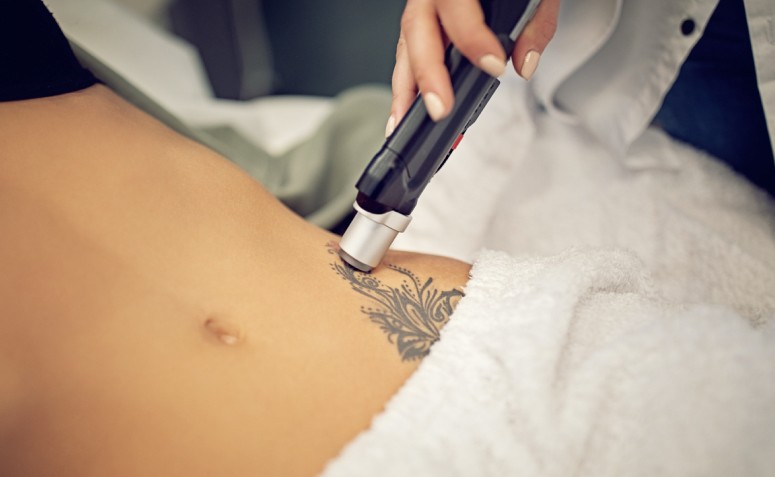 Conheça como são os procedimentos de remoção de tatuagem