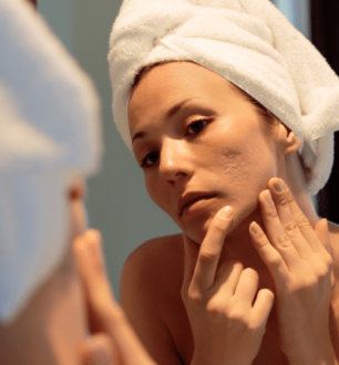 7 tipos de acne que podem afetar mulheres e como tratá-los