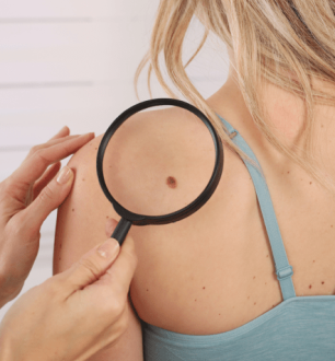 10 tipos de manchas escuras na pele e seus tratamentos