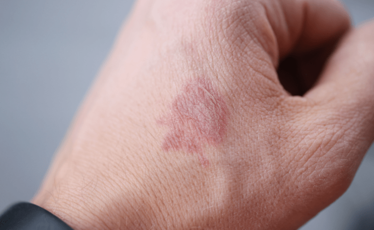 Manchas escuras na pele: 10 causas e diferentes formas de tratamento