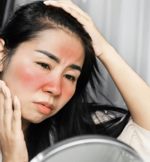 7 causas de vermelhidão no rosto para ficar de olho