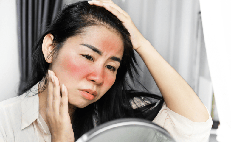 7 causas de vermelhidão no rosto para ficar de olho
