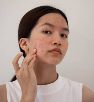 5 características da acne fúngica para identificar a doença e como prevenir