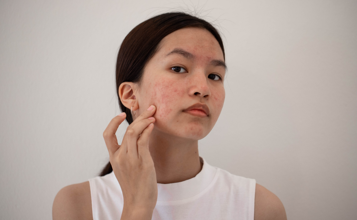 5 características da acne fúngica para identificar a doença e como prevenir