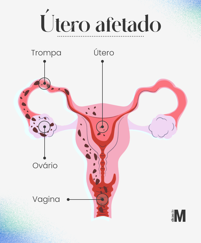 Infográfico como é um útero afetado pela endometriose