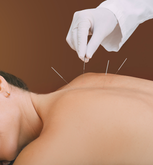 Conheça o Dry-Needling, técnica que alivia dores musculares